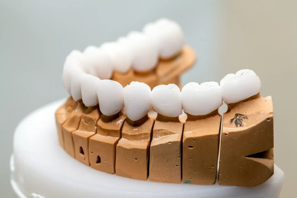 Brug op implantaten op een model
