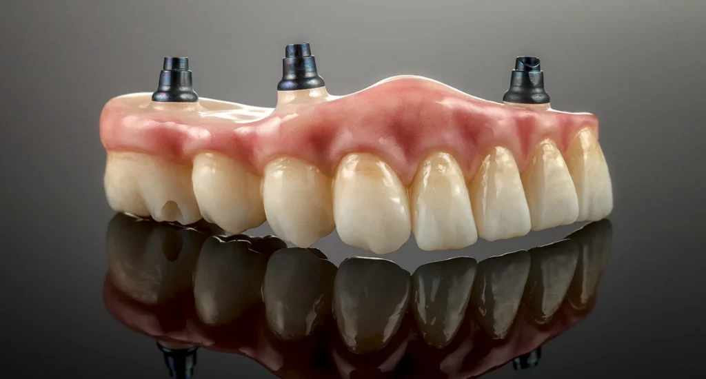 Prothese op implantaten